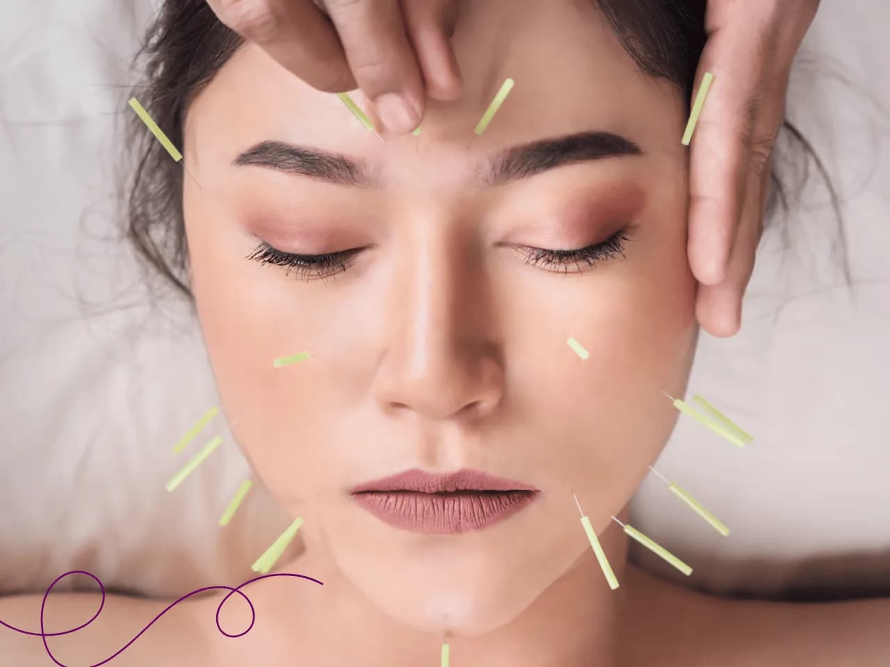 Imagen referencial sobre ¿Agujas en menopausia?